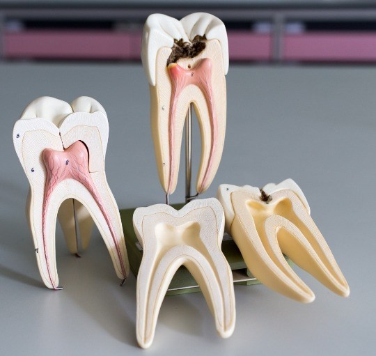 Models of damaged teeth needing root canal treatment in Honolulu
