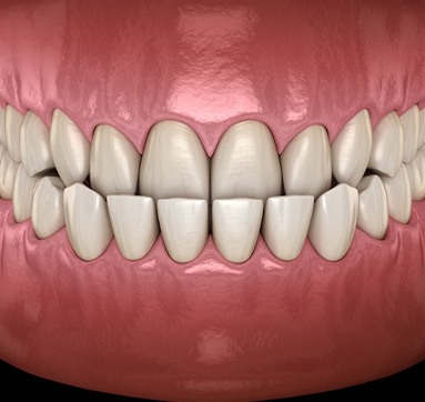 Man wears athletic mouthguard