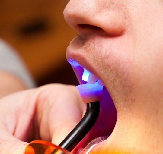 Dental patient getting cosmetic bonding on a front tooth