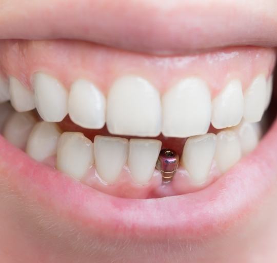 Close up of smile with dental implant replacing lower tooth