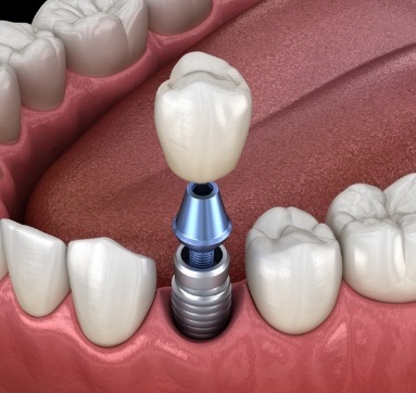 Dental crown being placed onto dental implant