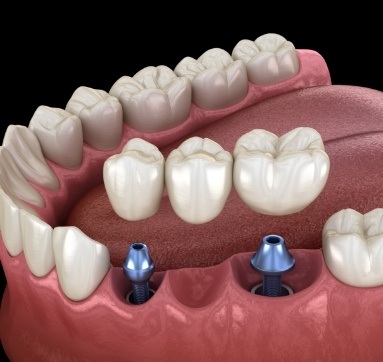 Dental bridge being placed onto two dental implants