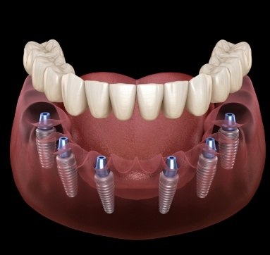 Full denture being placed onto six dental implants