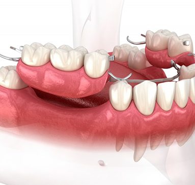 Illustration of partial dentures?