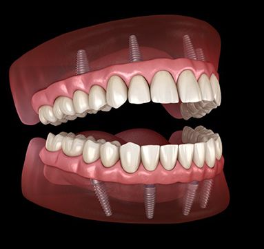 Illustration of implant dentures