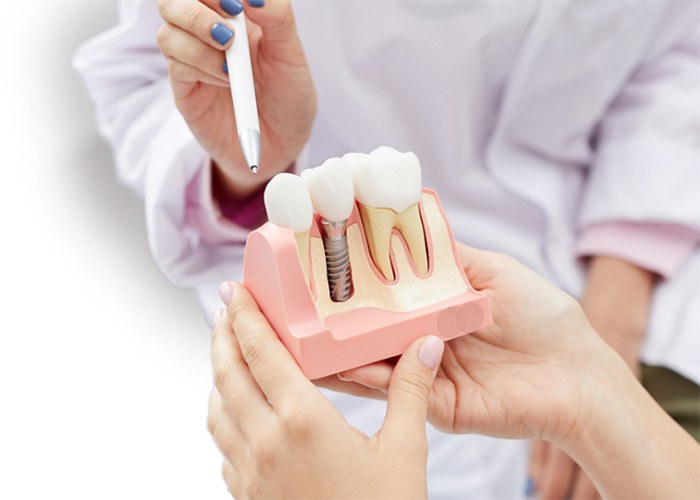 Dentist showing a model of a dental implant to a patient