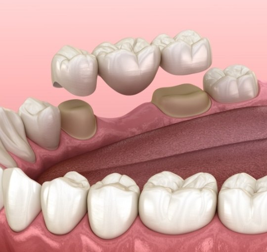 Illustrated dental bridge replacing a missing tooth