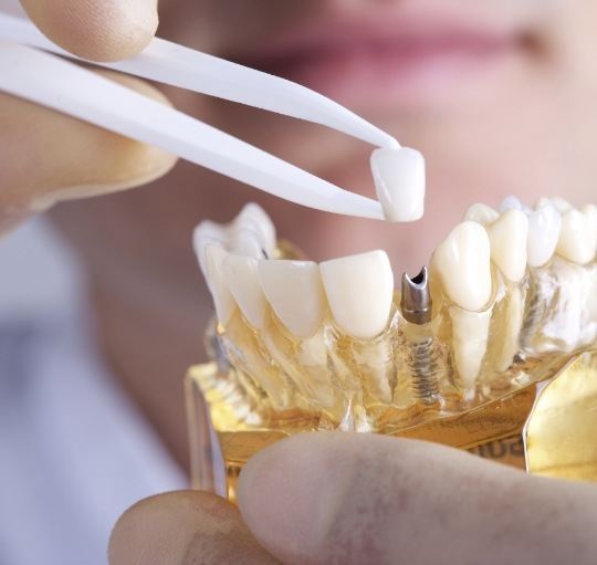 Person placing a dental crown on a dental implant in a model of the mouth