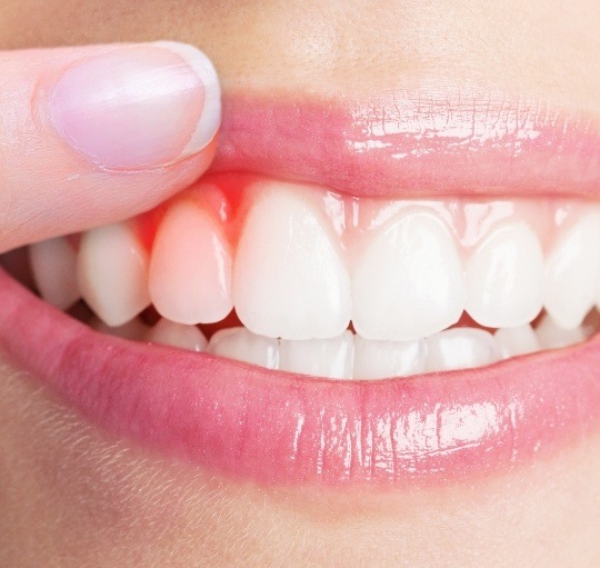 Close up of person pointing to red spot in their gums