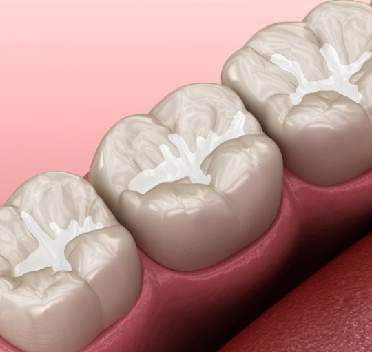 Illustrated row of teeth with barely noticeable fillings