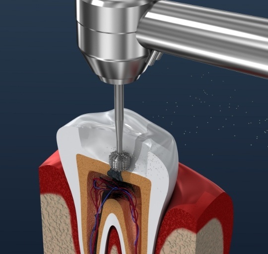 Illustrated dental instrument performing root canal treatment